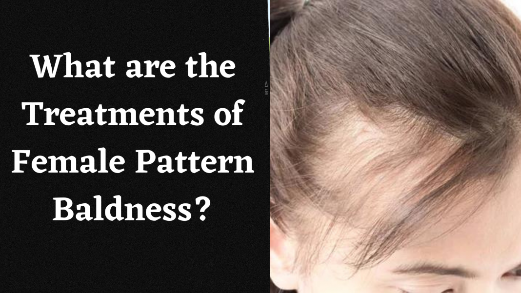 What are the Treatments of Female Pattern Baldness