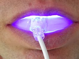 at-home-teeth-whitening